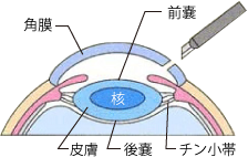 白内障の手術画像